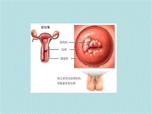 宫颈癌床诊断及分期-PPT文档资料.ppt