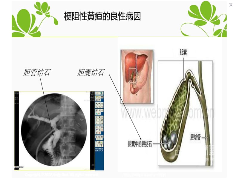 最新：梗阻性黄疸护理查房ppt课件-文档资料.ppt_第3页