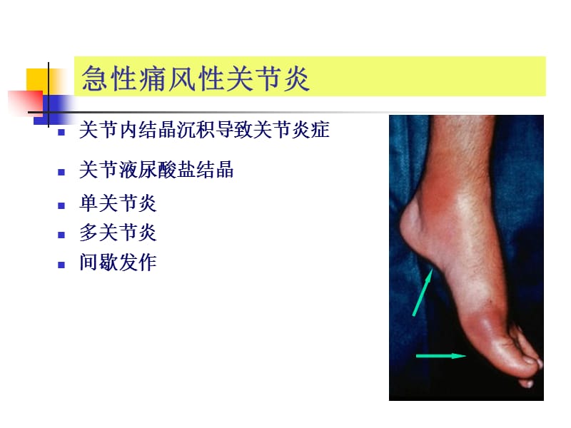 合理诊治痛风性关节炎的探讨课件-文档资料.ppt_第1页