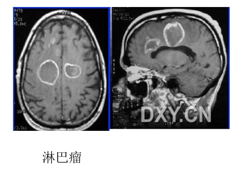 影像讨论总结环状强化的颅内疾病-文档资料.ppt_第1页