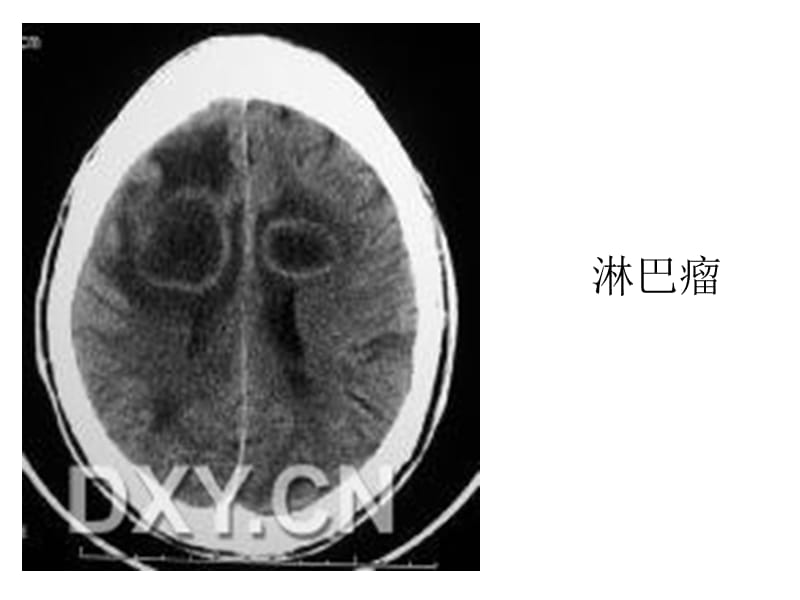 影像讨论总结环状强化的颅内疾病-文档资料.ppt_第2页