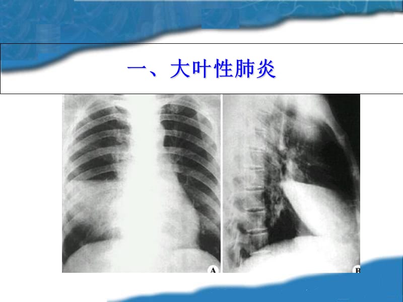 呼吸系统常见疾病的主要症状和体征-文档资料.ppt_第2页