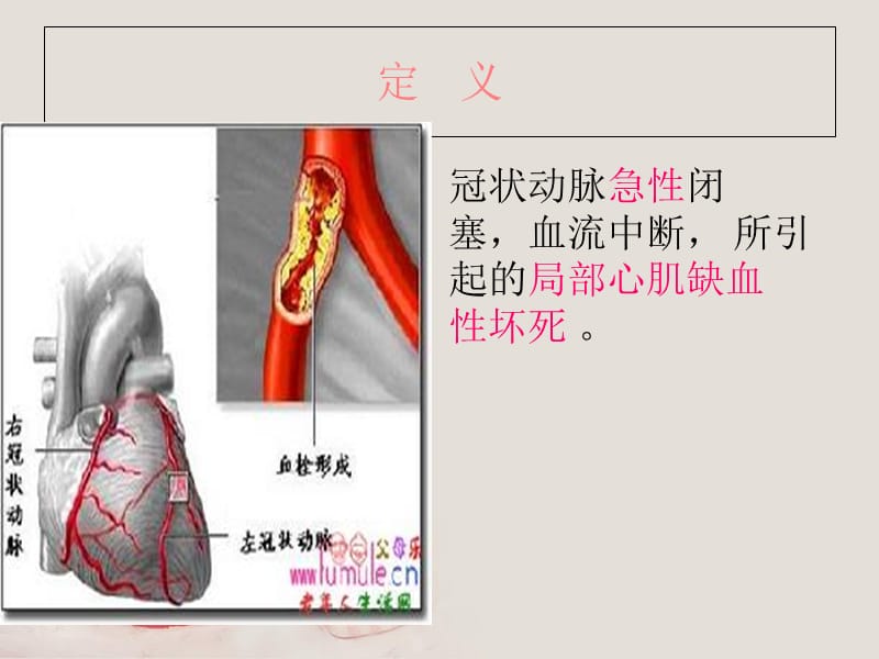 最新：急性心肌梗死的护理查房李艳丽-文档资料.ppt_第2页