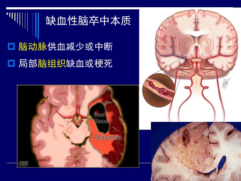 急性脑梗塞血管再通流程优化-PPT课件.ppt_第3页