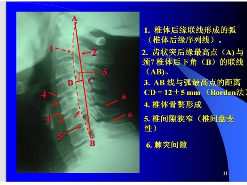 最新颈椎X片课件-PPT文档.ppt_第2页