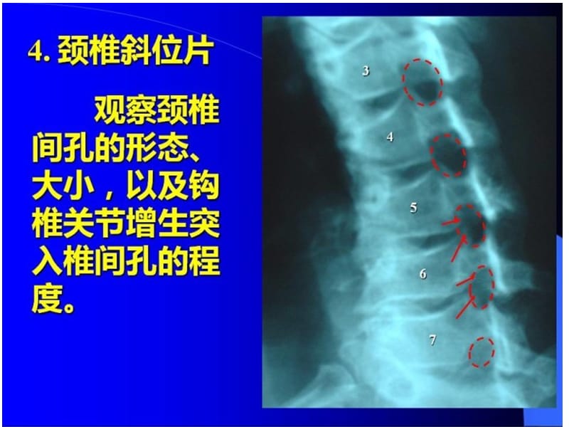 最新颈椎X片课件-PPT文档.ppt_第3页