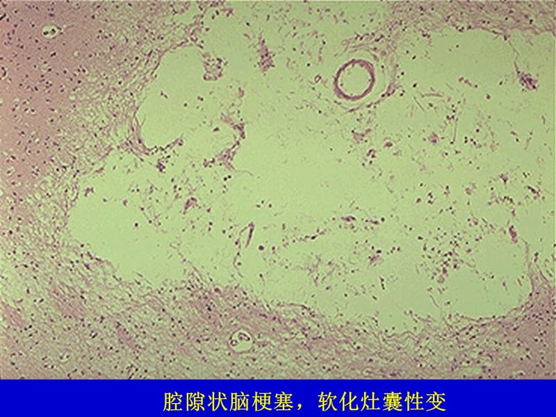 最新：病理学实习镜下--神经系统-文档资料.ppt_第3页