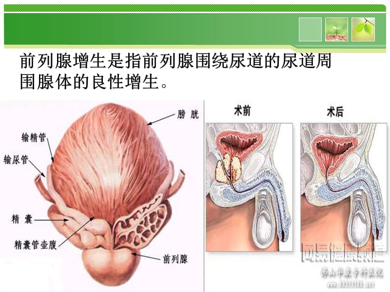 最新：前列腺围手术期护理分析课件-文档资料.ppt_第3页