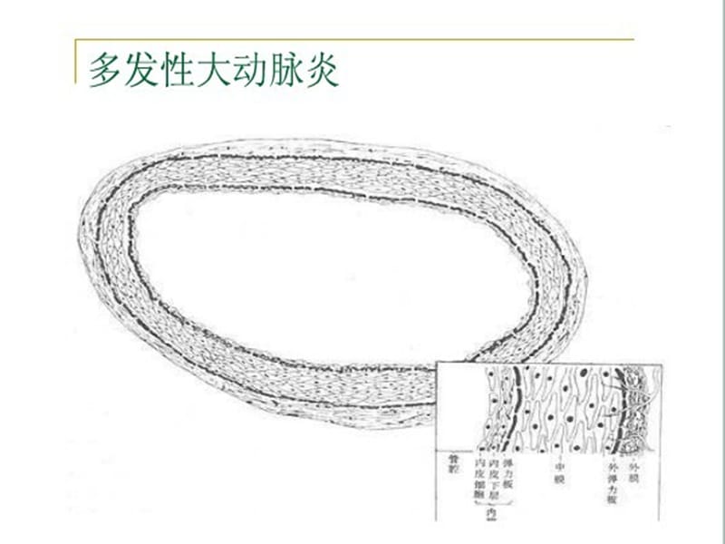 最新多发大动脉炎-PPT文档.ppt_第3页