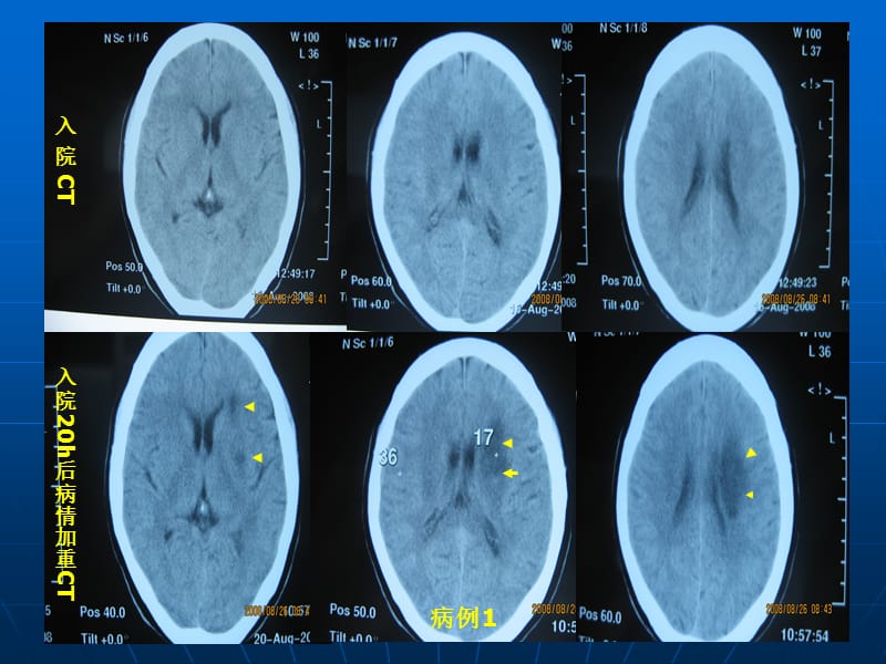 最新：脑分水岭梗死课件-文档资料.ppt_第2页