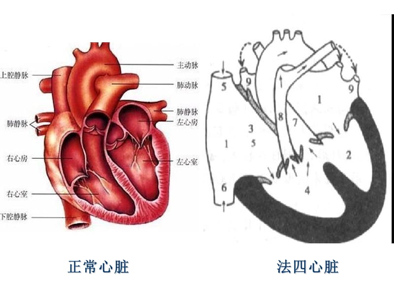 最新法洛氏四联症术后护理常规-PPT文档.ppt_第2页