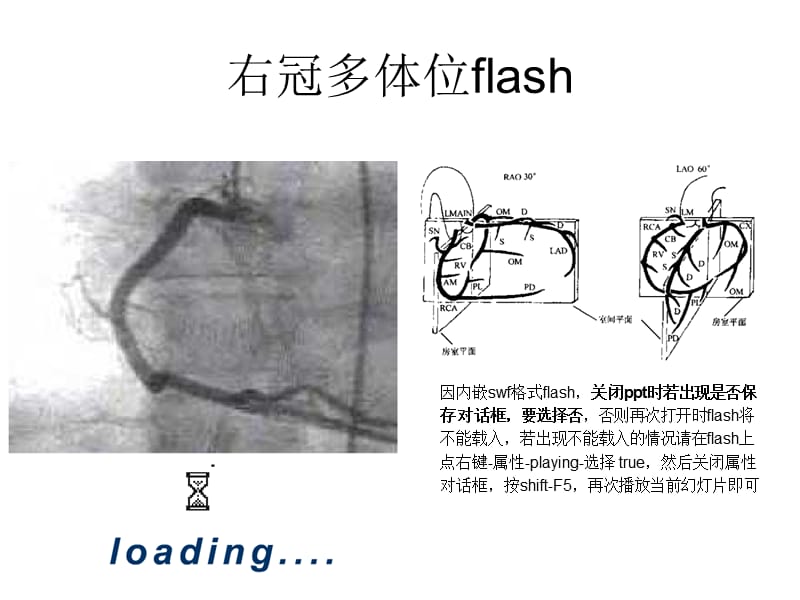 最新冠脉造影读片入门新-PPT文档.ppt_第2页