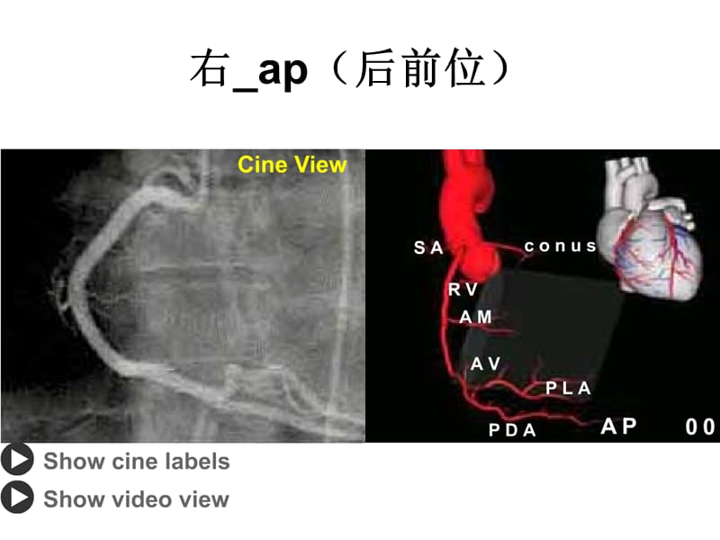 最新冠脉造影读片入门新-PPT文档.ppt_第3页