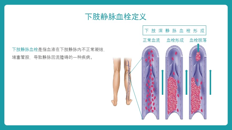 最新下肢静脉血栓查房-PPT文档.pptx_第1页