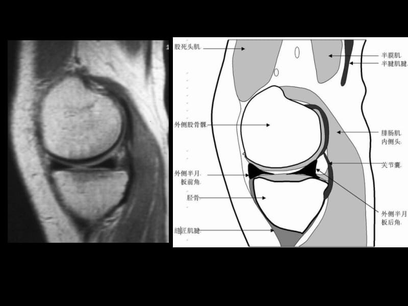 最新半月板和韧带核磁共振诊断课件-PPT文档.ppt_第3页