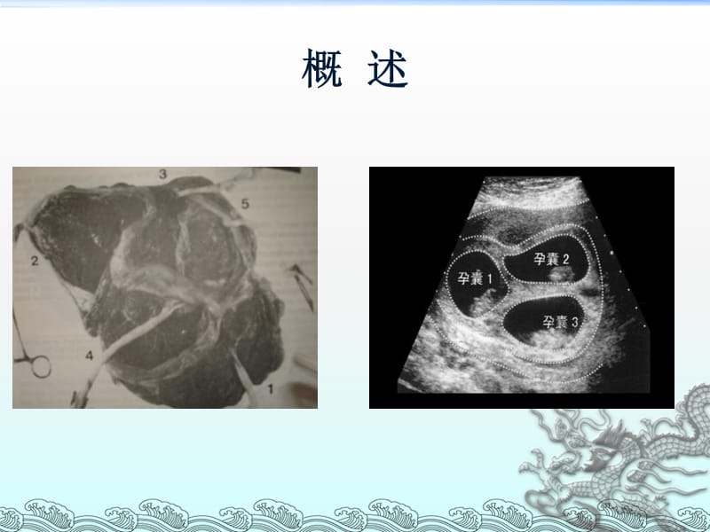 最新多胎及双胎妊娠-dremma-PPT文档.ppt_第2页