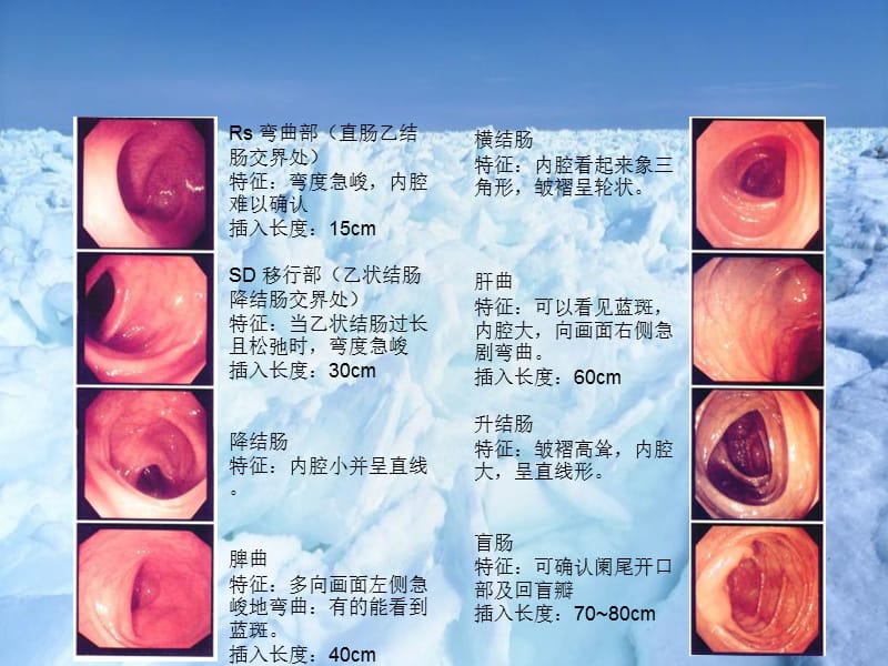 最新结肠镜单人操作中助手腹部压迫法-内镜中心-薛辉-PPT文档.ppt_第2页