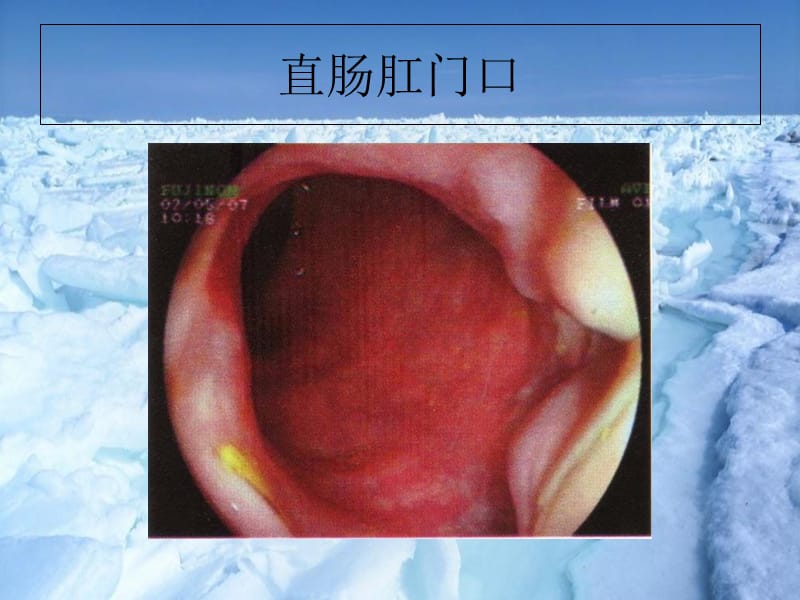 最新结肠镜单人操作中助手腹部压迫法-内镜中心-薛辉-PPT文档.ppt_第3页