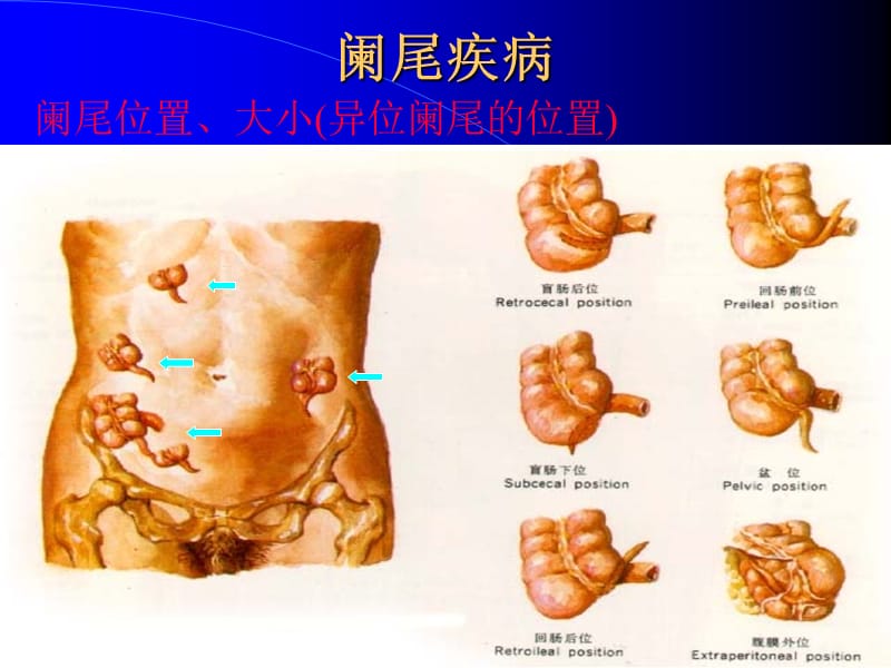 最新第三十八章阑尾疾病之二-PPT文档.ppt_第3页