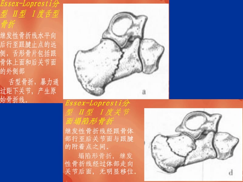 最新：跟骨折分型课件-文档资料.ppt_第3页