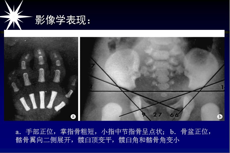 染色体病和遗传性疾病影像学诊断-PPT课件.ppt_第3页