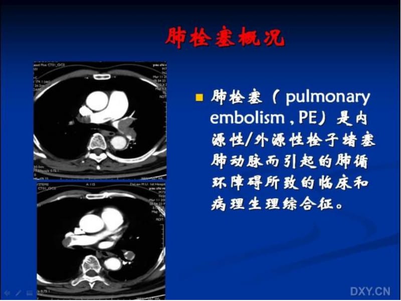 肺栓塞与肺梗死的影像学诊断.ppt_第2页