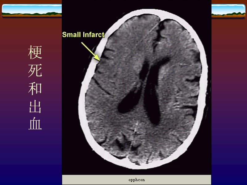 [临床医学]脑血管狭窄的诊断和药物治疗.ppt_第3页