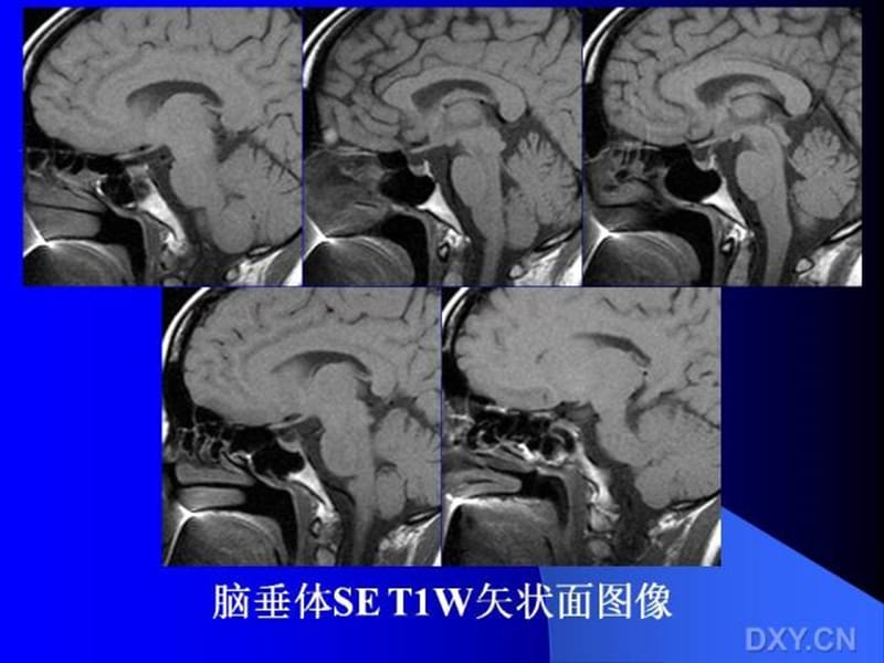 [临床医学]垂体瘤的MRI诊断及鉴别诊断.ppt_第3页