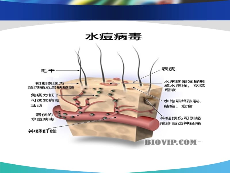 水痘.ppt_第3页