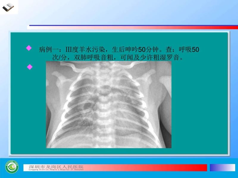 (结果版)新生儿胸片基本读片(共五例)_图文.ppt.ppt_第2页