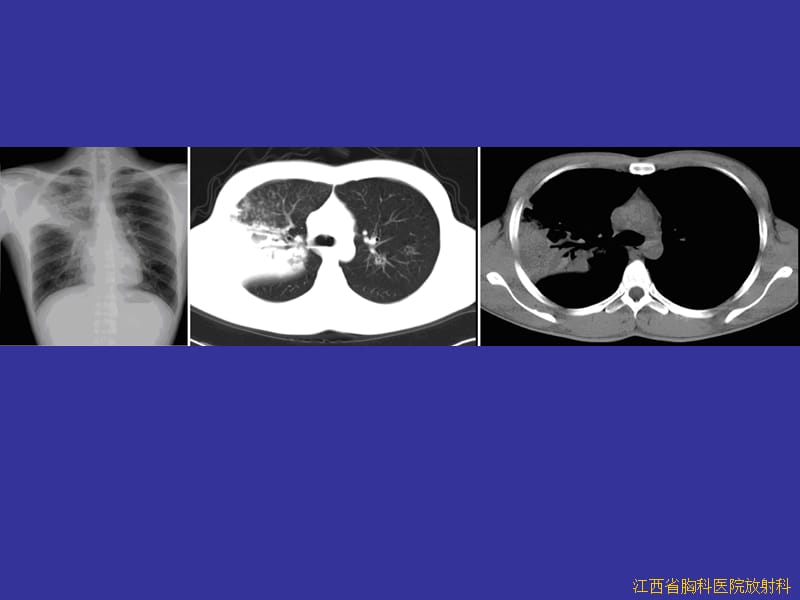 呼吸系统病例 ppt课件.ppt_第2页