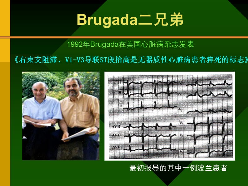 Brugada综合症的认识及其临床进展.ppt_第3页