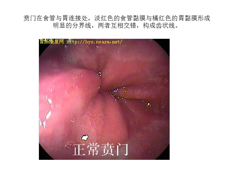 正常胃肠镜图片.ppt_第1页