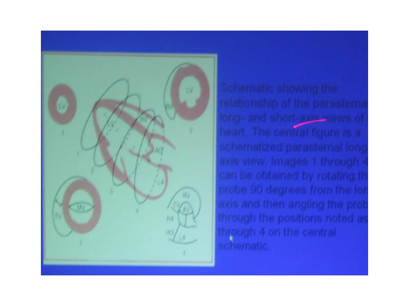 超声心动图在先心病中应用.ppt_第1页