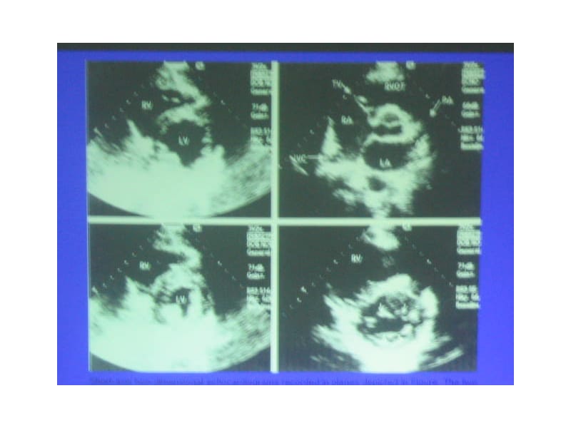 超声心动图在先心病中应用.ppt_第2页