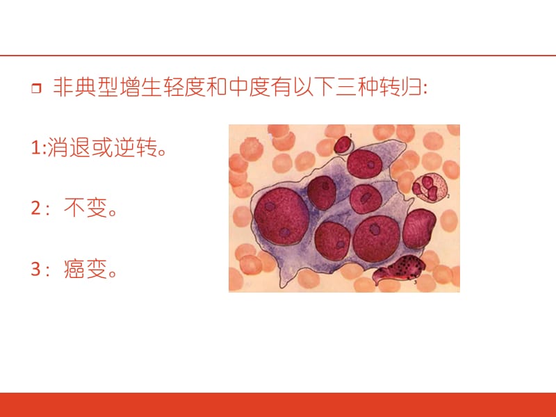 病理子宫灶性腺体不典型增生.ppt_第3页