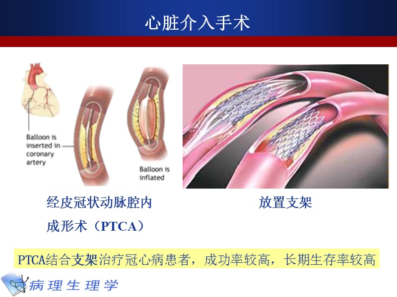 病理生理学10缺血-再灌注损伤.ppt_第2页