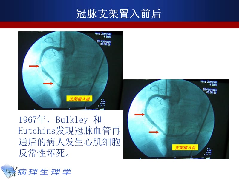 病理生理学10缺血-再灌注损伤.ppt_第3页