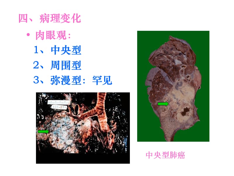 病理学-硅肺、肺癌、鼻咽癌(下部分).ppt_第3页