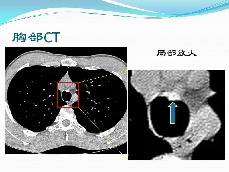 病例报告--气管支气管骨化病.ppt_第3页