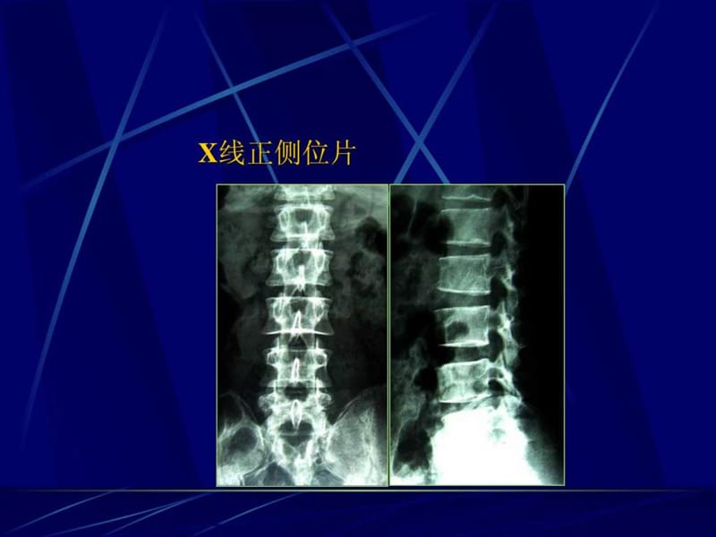 腰椎间盘突出症手术治疗(徐建广).ppt_第3页