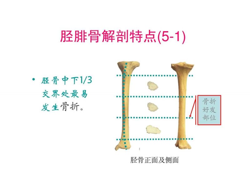 胫腓骨干骨折.ppt.ppt_第2页