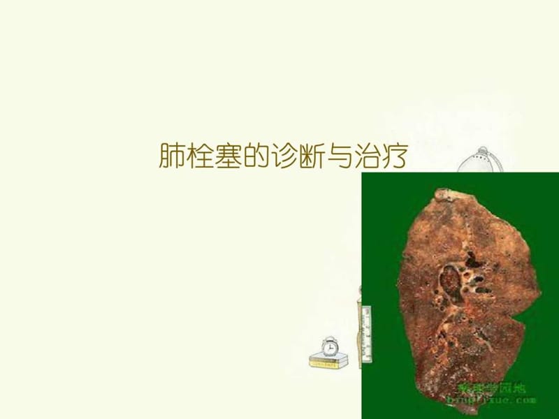 肺栓塞的诊治与治疗 ppt课件_图文.ppt.ppt_第1页