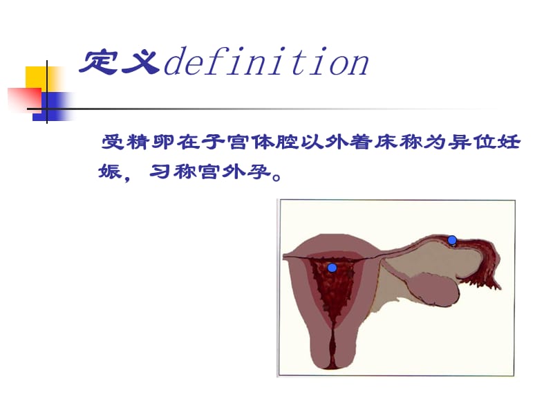 异位妊娠西医.ppt_第2页