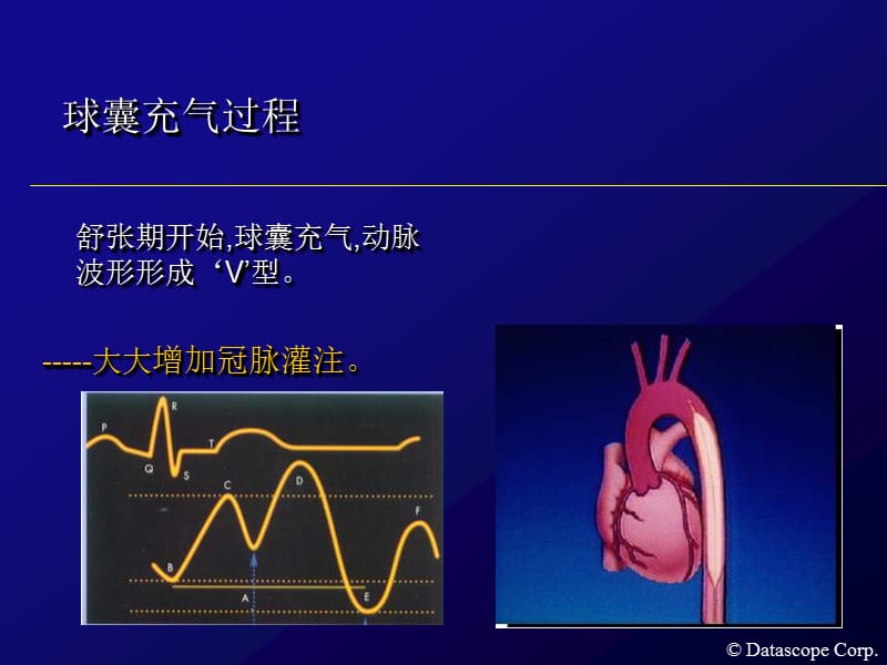 主动脉内球囊反搏泵的临床使用.ppt_第3页