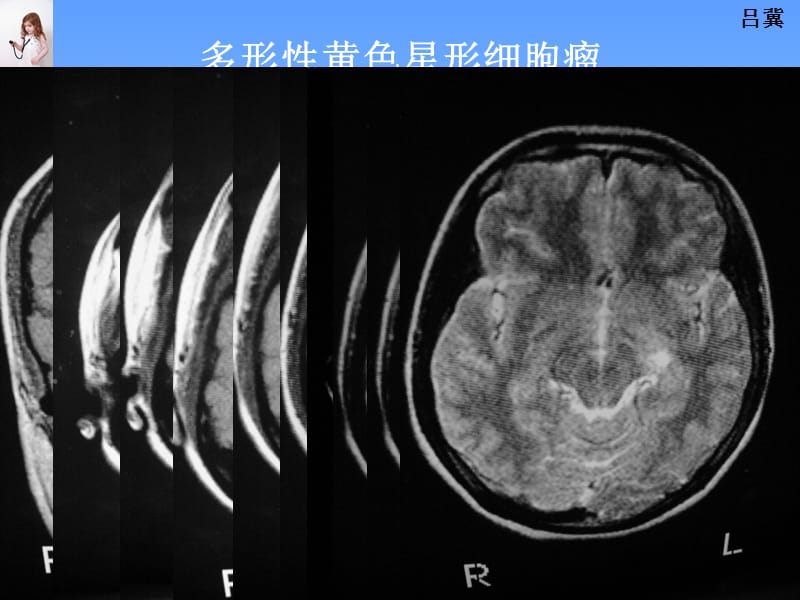 医影在线--CNS疾病MRI诊断(6).ppt_第2页