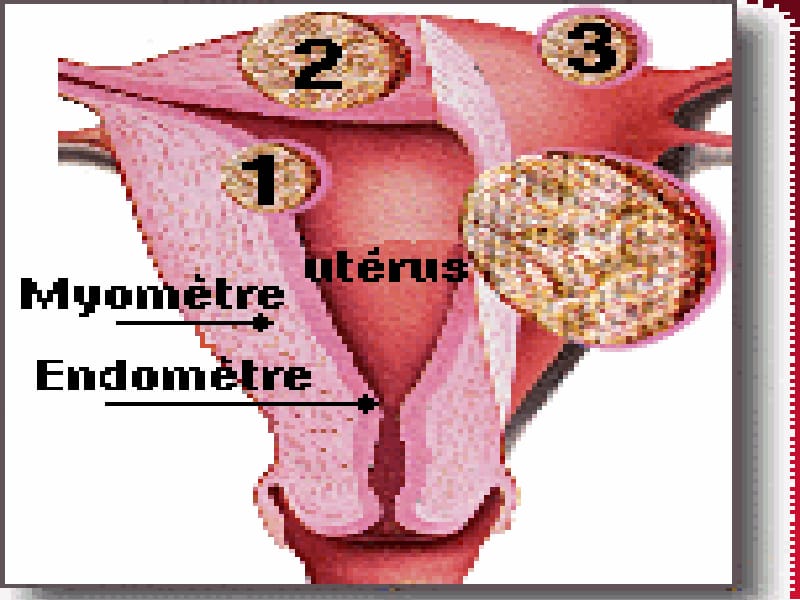 子宫内膜异位症艾星子endometriosis - Endometriosis.ppt_第3页