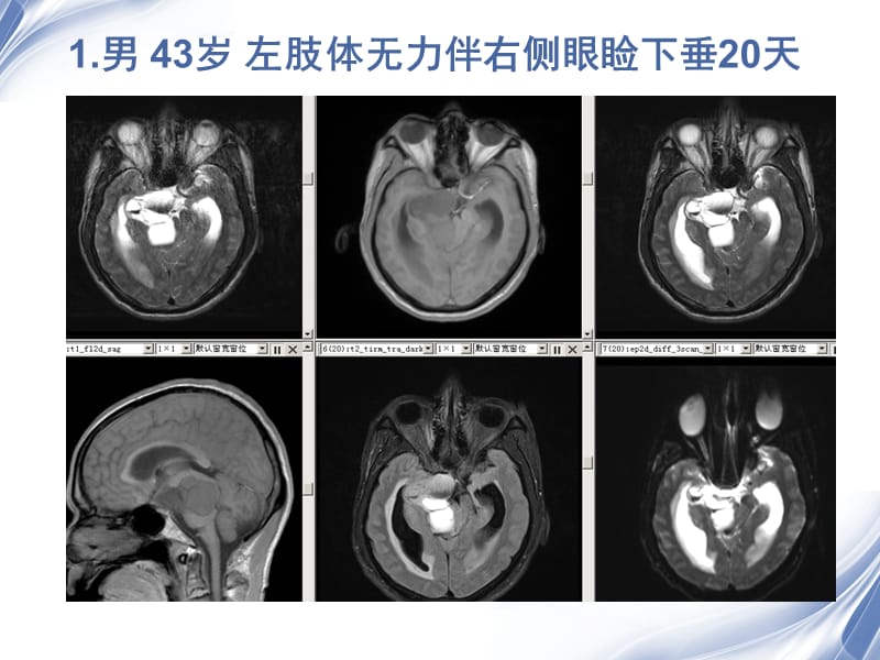 医学影像-垂体瘤的MR诊断与鉴别.ppt_第2页