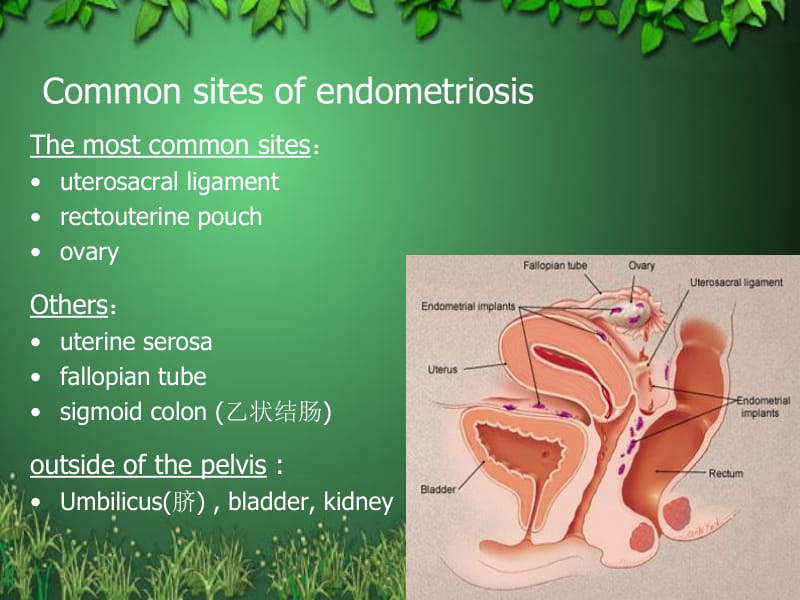 子宫内膜异位症(Endometriosis)-张喜.ppt_第3页