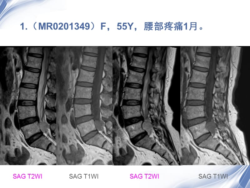 医学影像-病例随访椎管病变影像诊断.ppt_第2页